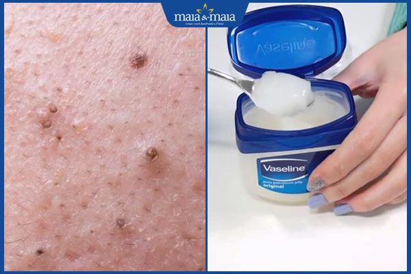 Trị mụn đầu đen bằng vaseline có tốt không? Gợi ý cách thực hiện 3 hiệu quả trị mụn đầu đen với vaseline