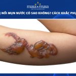 hình xăm bị nổi mụn nước