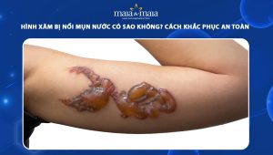 hình xăm bị nổi mụn nước