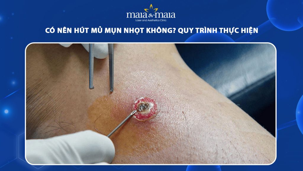 Có nên hút mủ mụn nhọt không? Quy trình thực hiện 1 hút mủ mụn nhọt