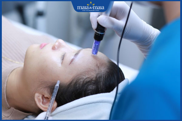 Có nên hút mủ mụn nhọt không? Quy trình thực hiện 2 hút mủ nốt mụn