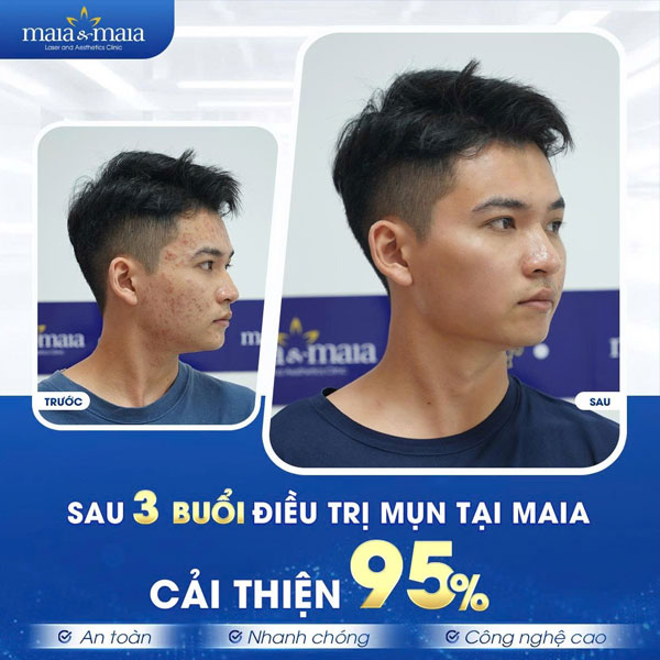 khách chữa hết mụn tại maia