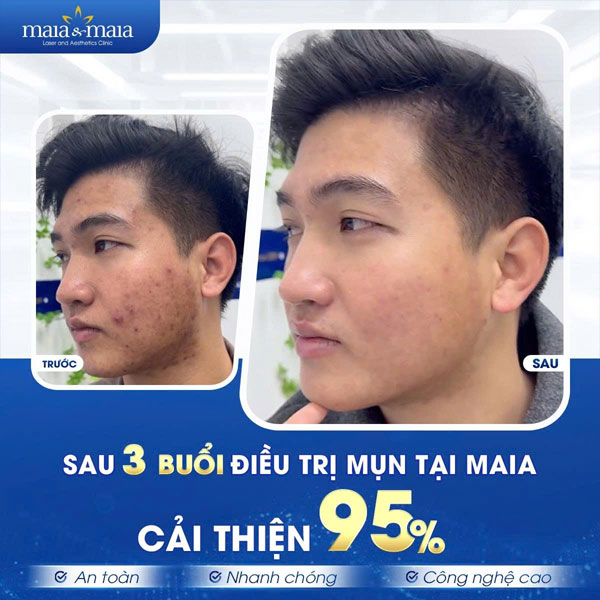 khách chữa mụn thành công tại maia
