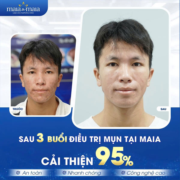 khách trị mụn thành công tại maia