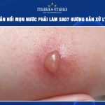 kiến cắn nổi mụn nước