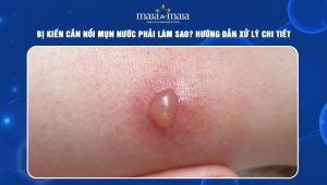 kiến cắn nổi mụn nước