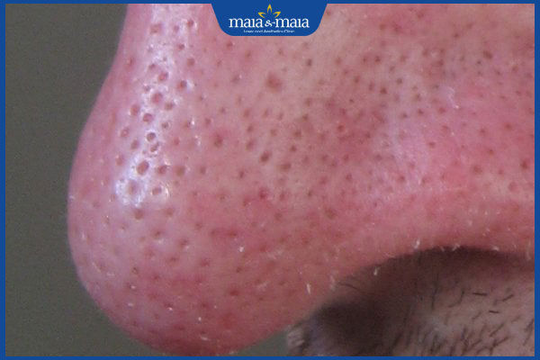 lỗ chân lông ở mũi to