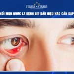 mí mắt nổi mụn nước