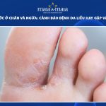 mọc mụn nước ở chân và ngứa