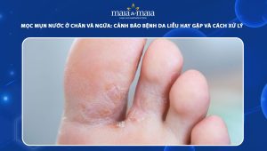 mọc mụn nước ở chân và ngứa
