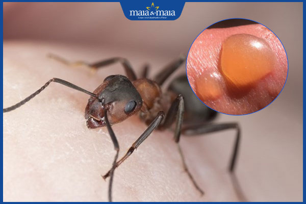 Bị kiến lửa cắn nổi mụn nước có nguy hiểm không? Cách xử lý 3 mức độ nguy hiểm do kiến cắn