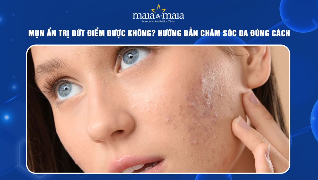 Mụn ẩn có trị dứt điểm được không? Hướng dẫn chăm sóc da 1 mụn ẩn