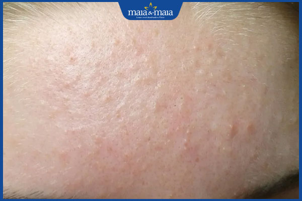 mụn ẩn mọc trên trán