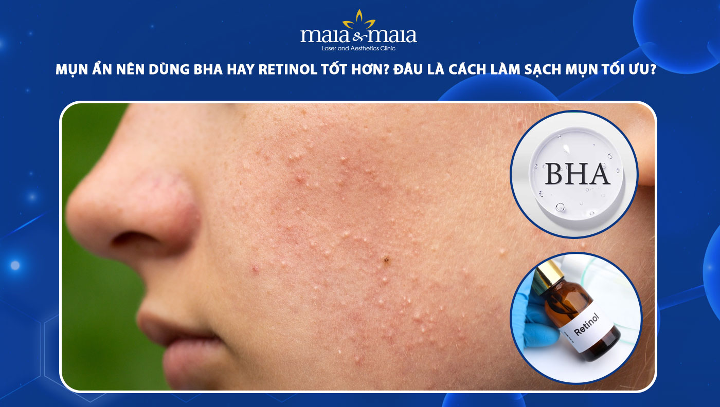 mụn ẩn nên dùng BHA hay retinol