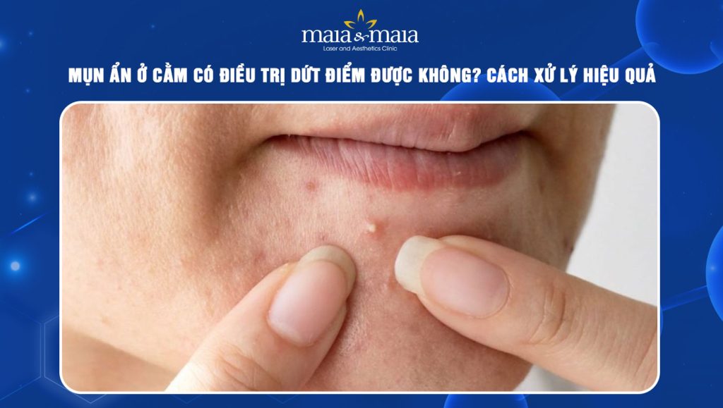 mụn ẩn ở cằm