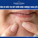 mụn ẩn ở cằm