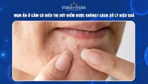 mụn ẩn ở cằm