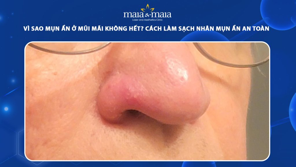 mụn ẩn ở mũi