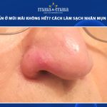 mụn ẩn ở mũi