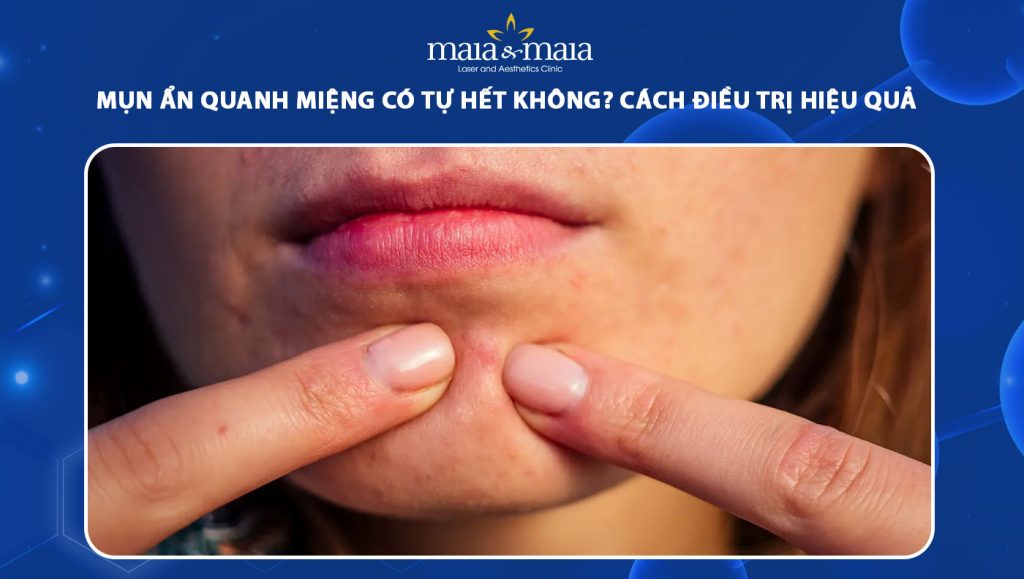 mụn ẩn quanh miệng