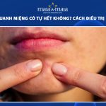 mụn ẩn quanh miệng