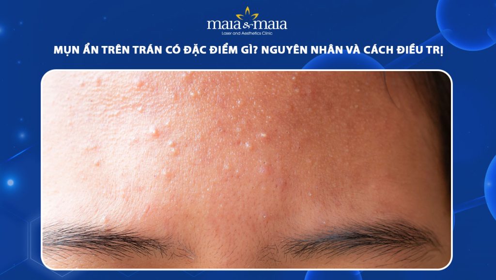 mụn ẩn trên trán