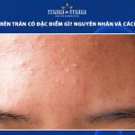 mụn ẩn trên trán