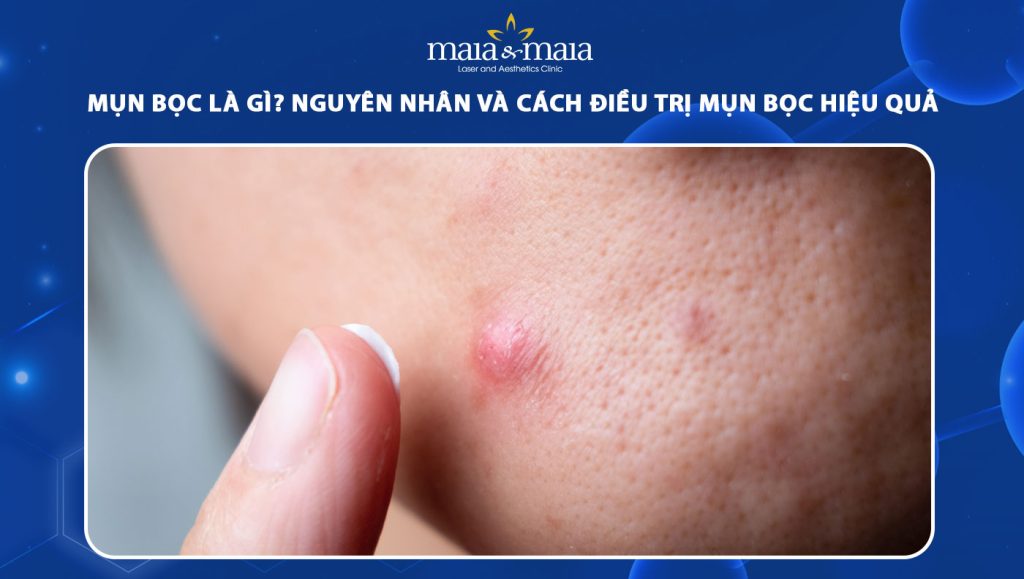 Mụn bọc là gì? Nguyên nhân và cách điều trị mụn bọc hiệu quả 1 mụn bọc