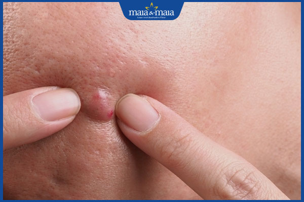 mụn bọc chai cứng