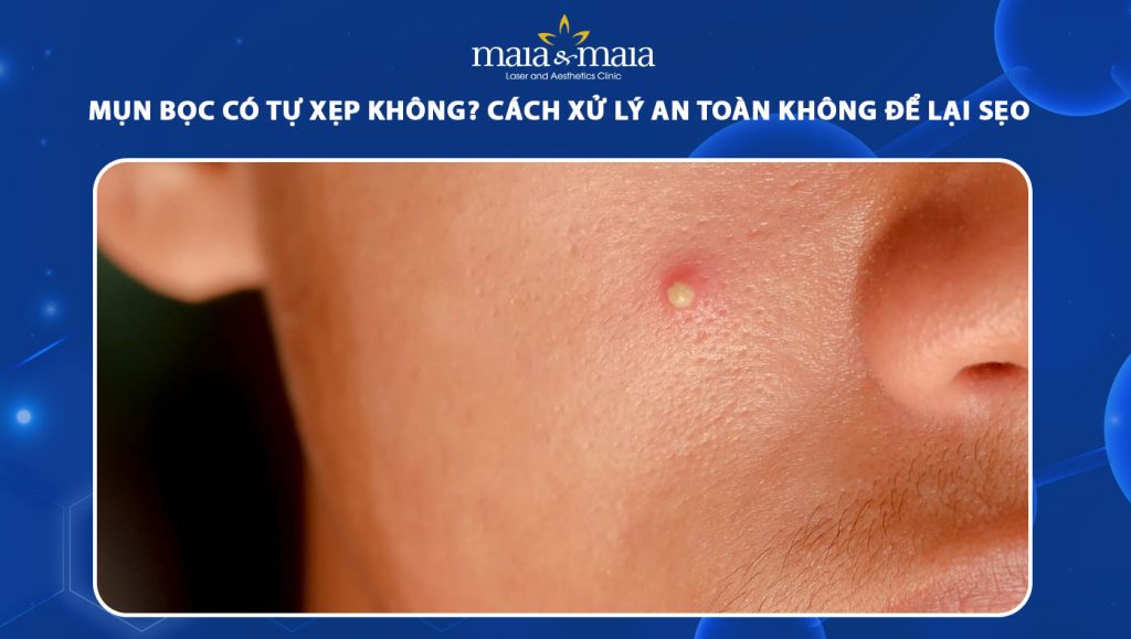 Mụn bọc có tự xẹp không? Cách xử lý an toàn không để lại sẹo 1 mụn bọc có tự xẹp không