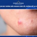 mụn bọc không đầu