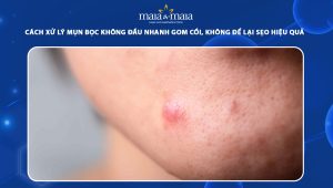 mụn bọc không đầu