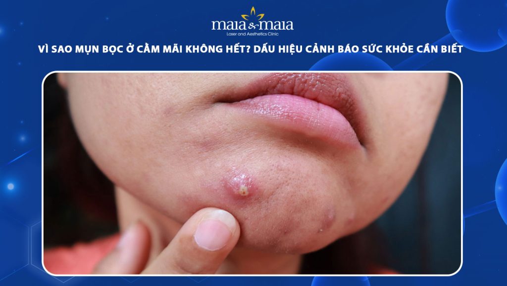 Vì sao mụn bọc ở cằm mãi không hết? Cách xử lý hiệu quả 1 mụn bọc ở cằm