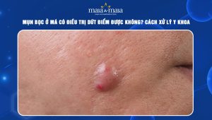 mụn bọc ở má