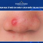 mụn bọc ở mũi