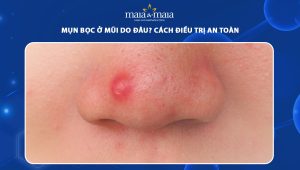 mụn bọc ở mũi