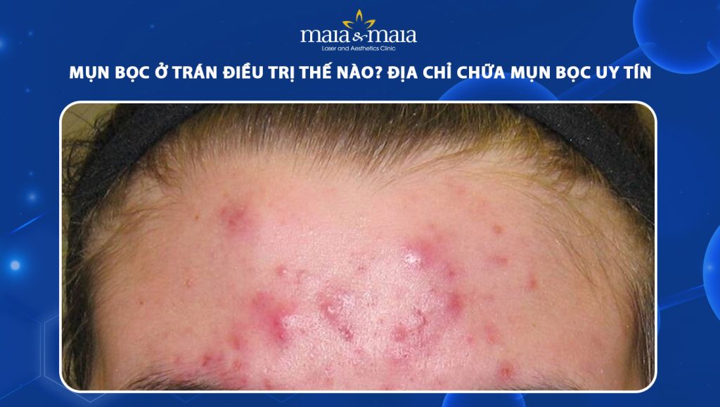 mụn bọc ở trán