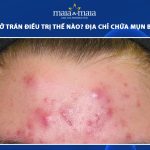 mụn bọc ở trán