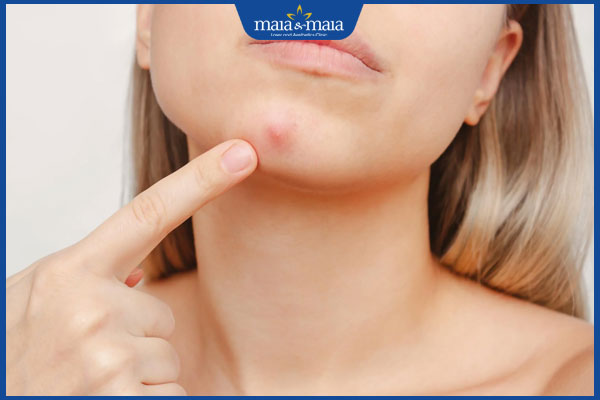 Vì sao mụn bọc ở cằm mãi không hết? Cách xử lý hiệu quả 2 mụn bọc ở vùng cằm