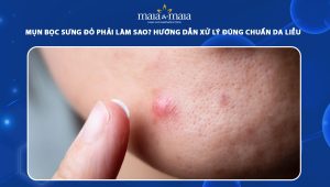 mụn bọc sưng đỏ