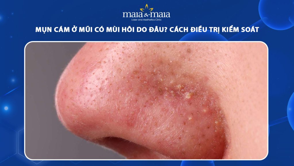 Mụn cám ở mũi có mùi hôi do đâu? Cách điều trị kiểm soát 1 mụn cám ở mũi có mùi hôi