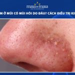 mụn cám ở mũi có mùi hôi