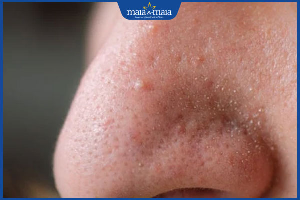 Mụn cám ở mũi có mùi hôi do đâu? Cách điều trị kiểm soát 2 mụn cám ở mũi