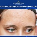 mụn cám ở trán