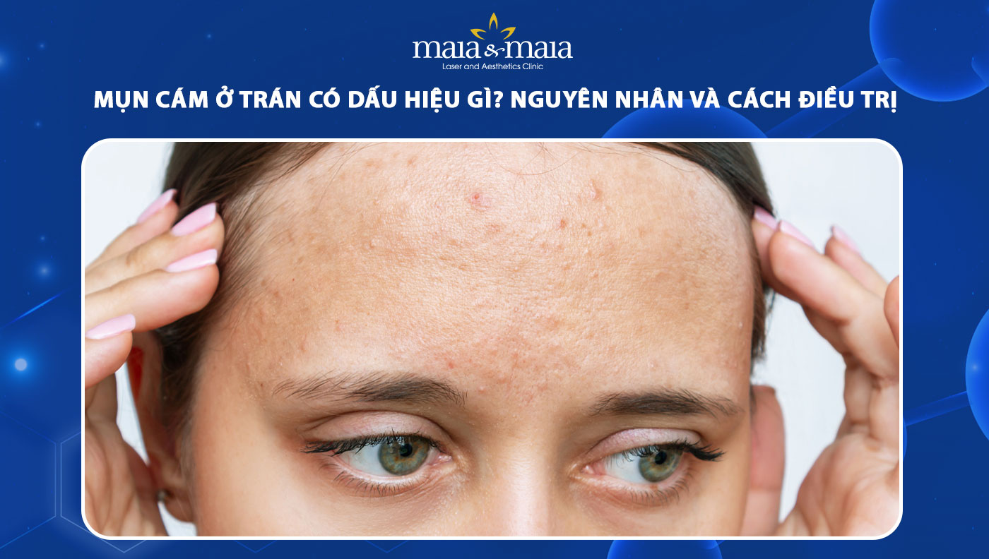 mụn cám ở trán