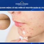 mụn cám quanh miệng