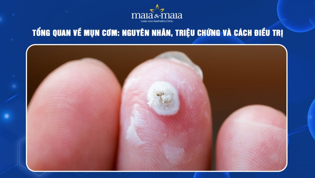 Tổng quan về mụn cơm: Nguyên nhân, triệu chứng và cách điều trị 1 mụn cơm