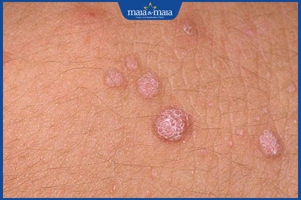 Tổng quan về mụn cơm: Nguyên nhân, triệu chứng và cách điều trị 3 mụn cơm lan rộng