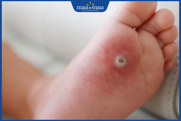 Tổng quan về mụn cơm: Nguyên nhân, triệu chứng và cách điều trị 2 mụn cơm ở lòng bàn chân