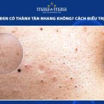 mụn đầu đen có thành tàn nhang